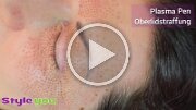 plasma_pen_oberlidstraffung