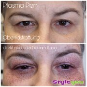 plasmapen_oberlidstraffung02