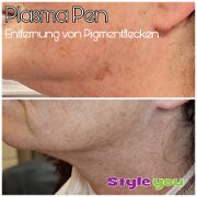 plasmapen_pigmentfleck01